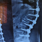 Spinal Degenerative Disc Disease Treatment