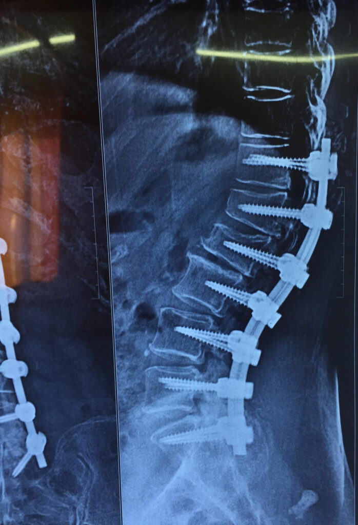 Spinal Degenerative Disc Disease Treatment